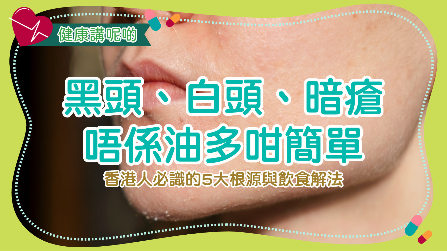 黑頭、白頭、暗瘡唔係油多咁簡單！香港人必識的5大根源與飲食解法